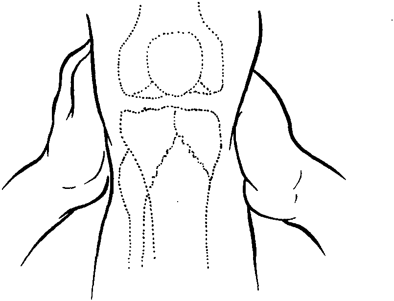 2 胫骨上端T形或Y形骨折切开复位内固定术
